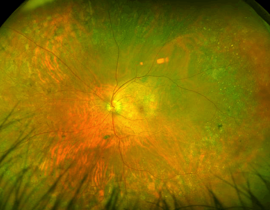 The Wide Spectrum of Peripheral Retinal Disease in AMD