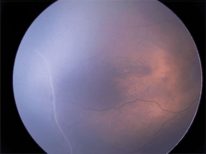 Update on the Diagnosis and Management of Retinopathy of Prematurity