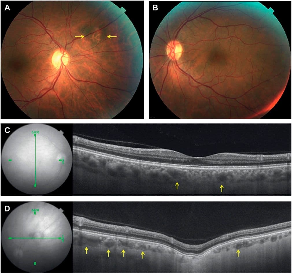 An Optometrist's Guide to Pachychoroid Spectrum Conditions