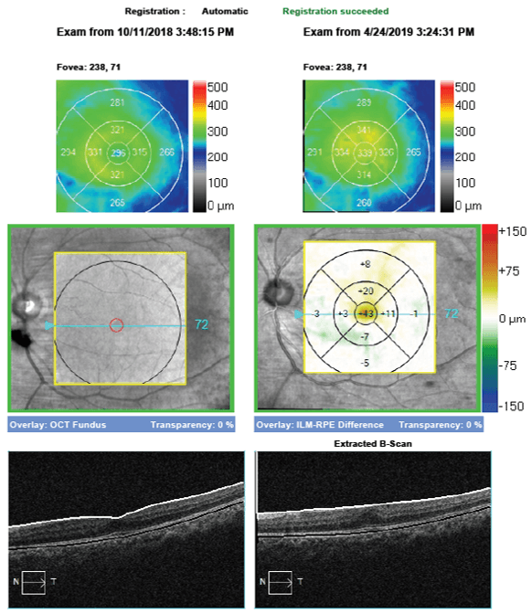 Oct Raster Scan Zeiss OCT Retinal Bootcamp
