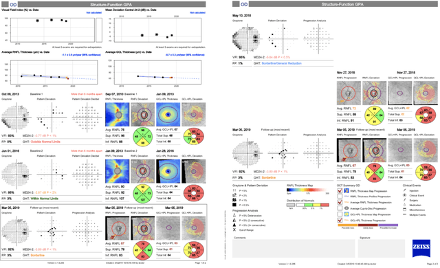 Multi Progression Visual Glaucoma Progression: Putting All the Pieces Together