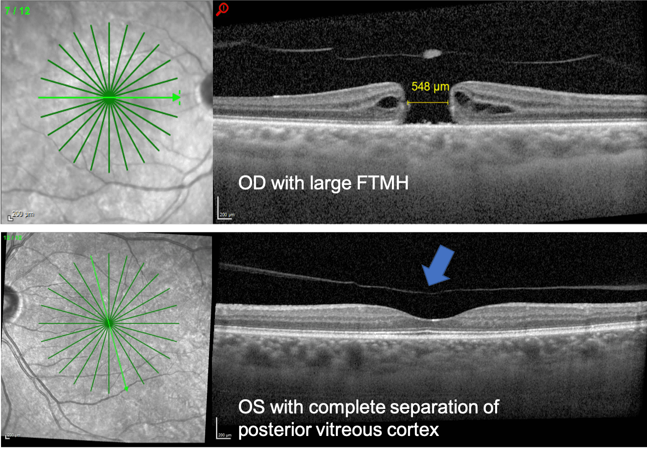 Step-by-Step Review and Pearls for Macular Hole Staging with Cheat Sheet