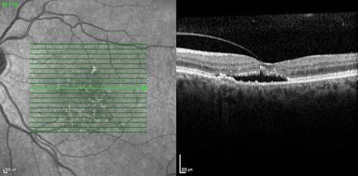 Csr Inoptometry Taking a Deeper Look at the Link Between CSR and AMD with Differential ...