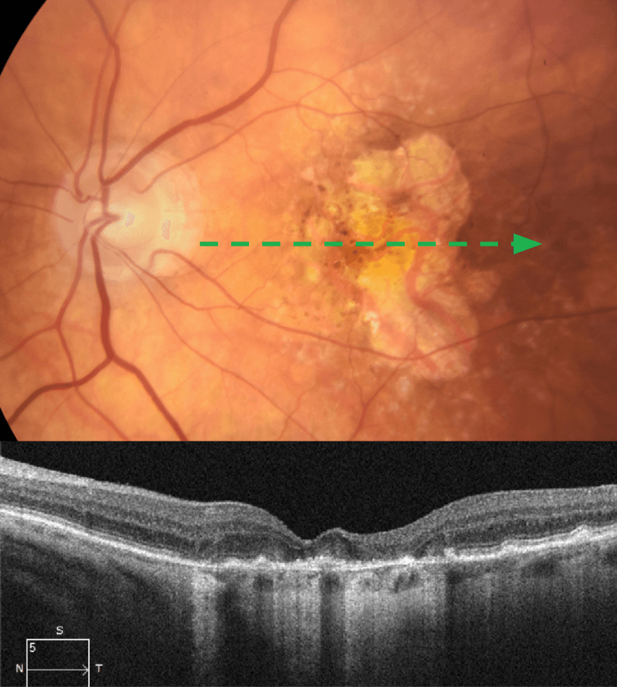 Oct Defect Above Rpe How Geographic Atrophy Impacts Functional Vision