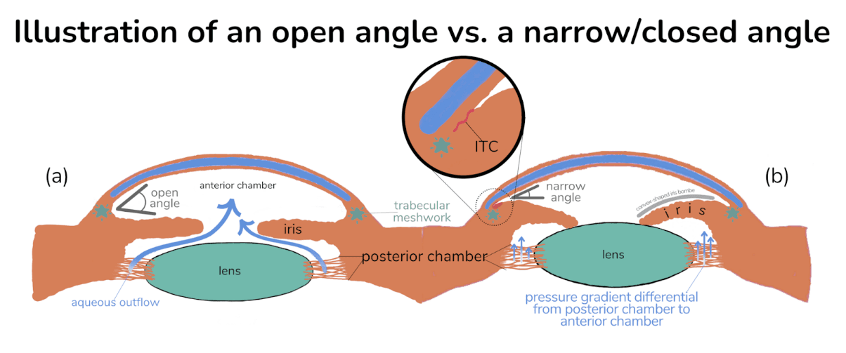 Open Angles Acute Angle Closure Crisis Protocol with Cheat Sheet