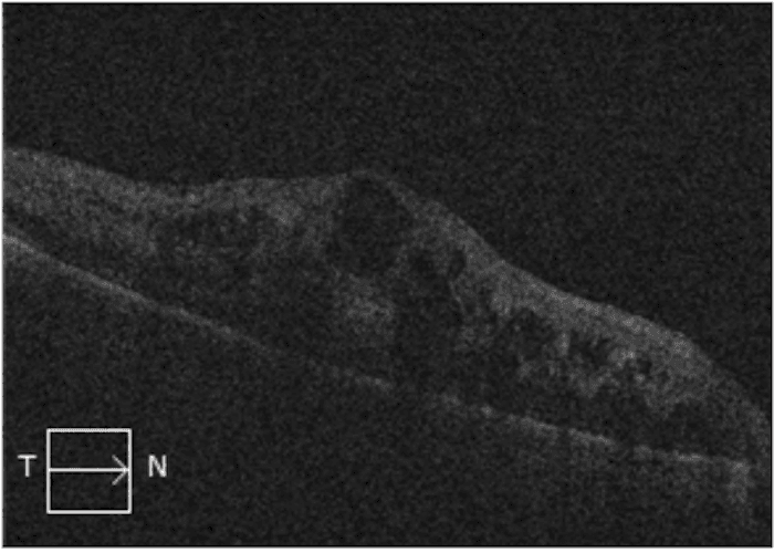 Macular Rvo The OD's Guide to Retinal Vein Occlusion with Cheat Sheet