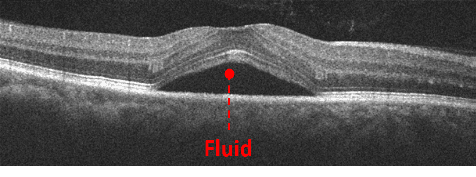 Into the Woods: Interpreting OCT Imaging in Retinal Disease