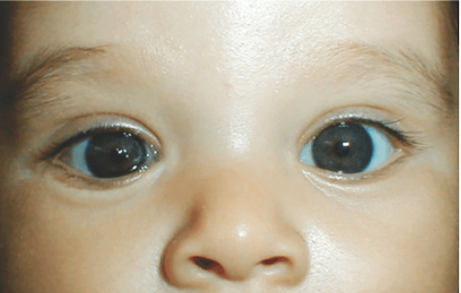 A Guide to Nasolacrimal Duct Obstruction in Pediatric Patients