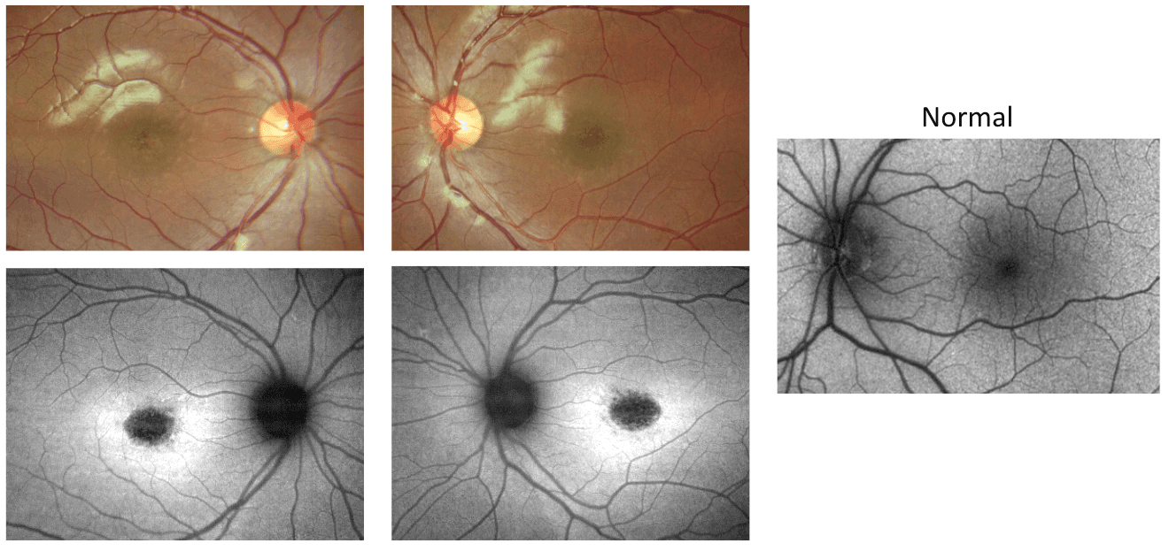 Spotting Inherited Retinal Disease on Imaging