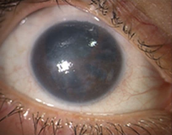 Correctopia ICE, ICE Baby: Iridocorneal Endothelial Syndrome and Secondary Glaucoma