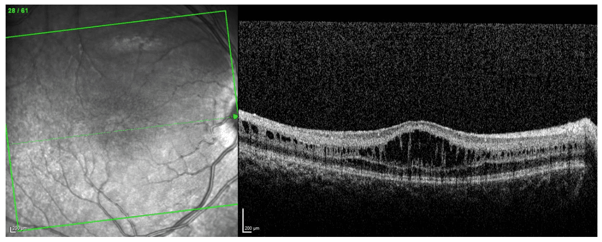 The Ophthalmology Resident's Guide to Inherited Macular Dystrophies ...