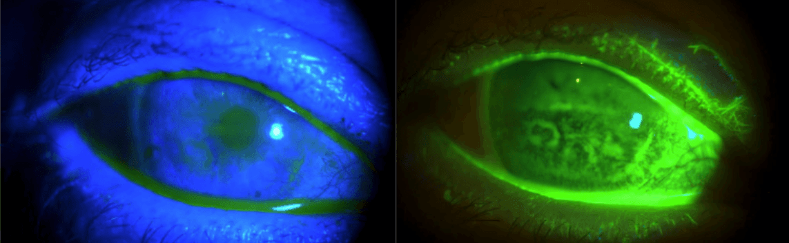 Ebmd Vs Rce The Ultimate Guide to the Management of Recurrent Corneal Erosions for ODs