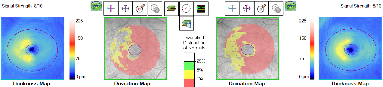 A Guide to Non-Glaucomatous Optic Nerve Disease