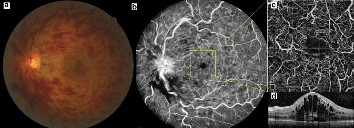 The OD's Guide to Retinal Vein Occlusion with Cheat Sheet