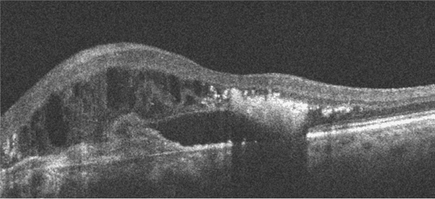 Progressive Atrophy Rpe The Optometrist's Guide to Geographic Atrophy