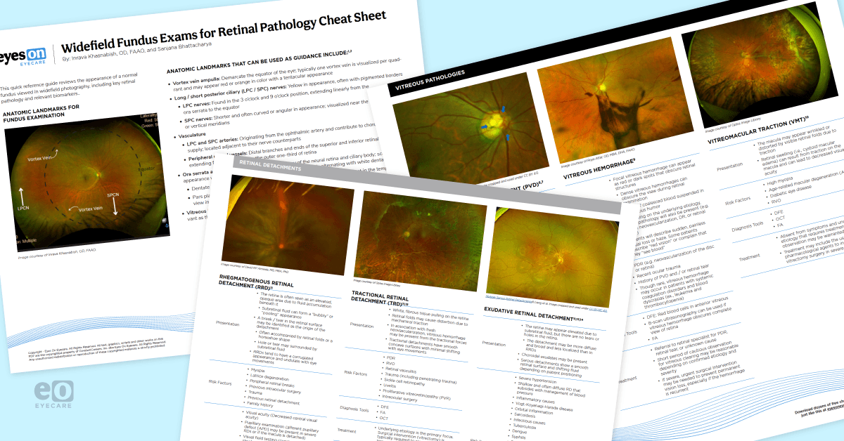 Fundus Microscope The Ultimate Guide to Identifying Retinal Disease on Fundus Photography