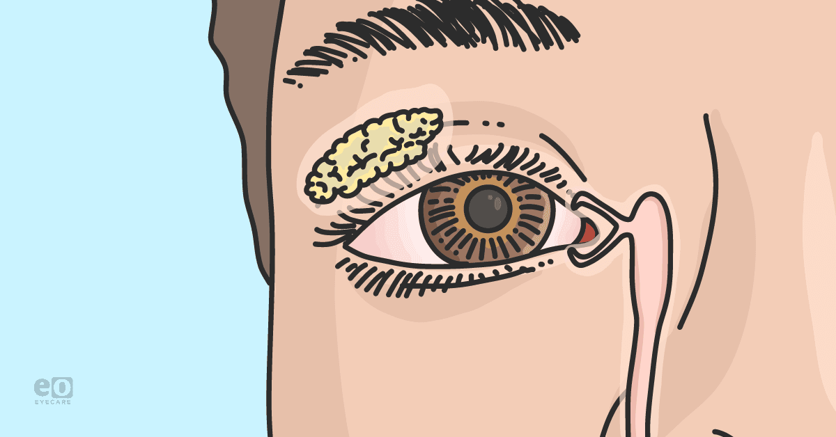 A Guide to Nasolacrimal Duct Obstruction in Pediatric Patients