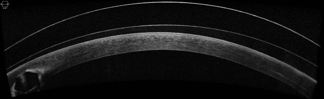 Top 5 Conditions to Treat with Scleral Lenses