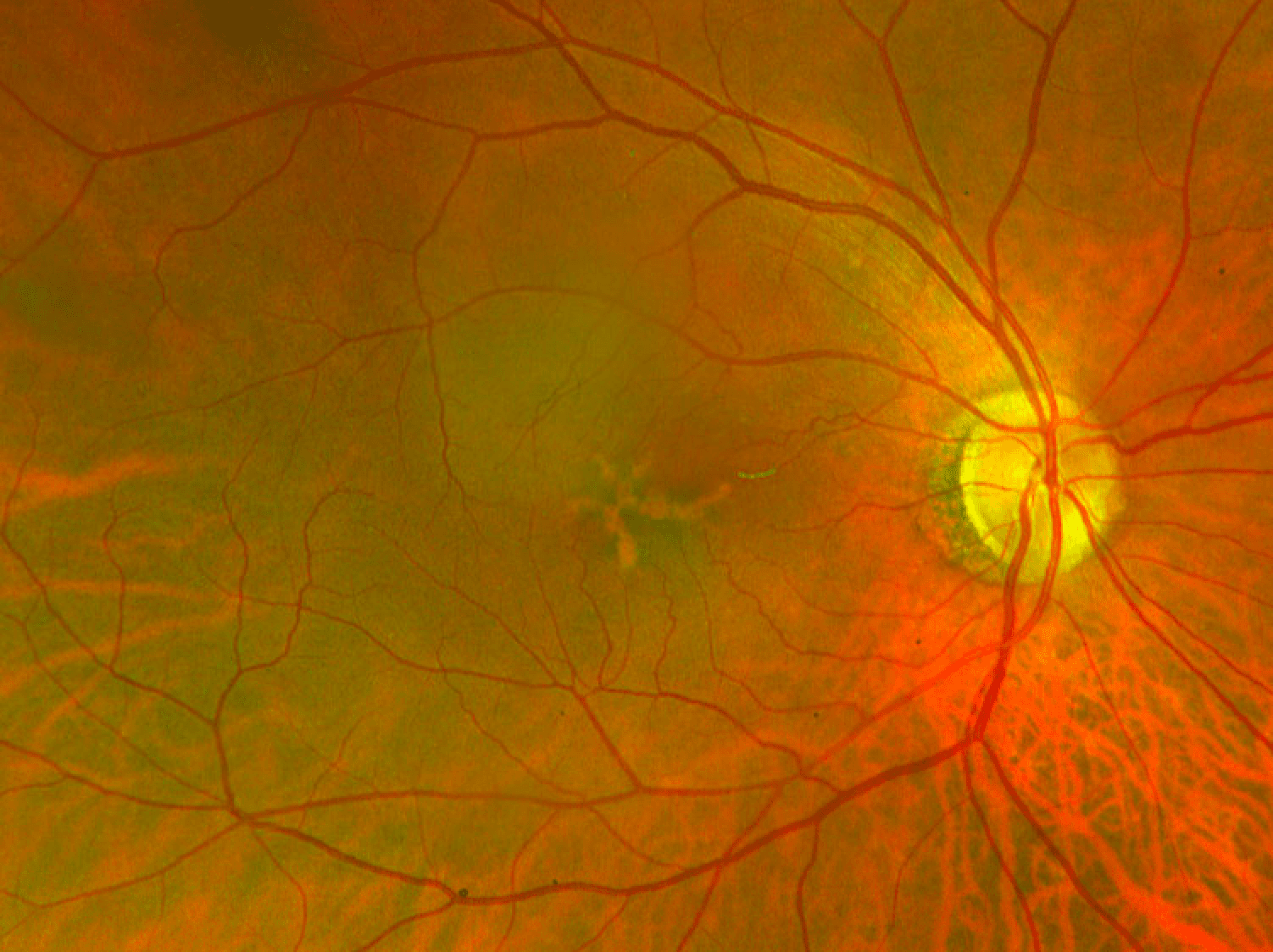 The Ophthalmology Resident's Guide to Inherited Macular Dystrophies ...