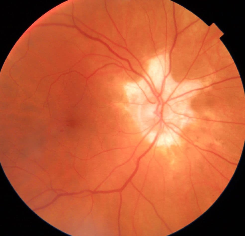 Optic Disc Insert A Guide to Optic Disc Abnormalities with Cheat Sheet
