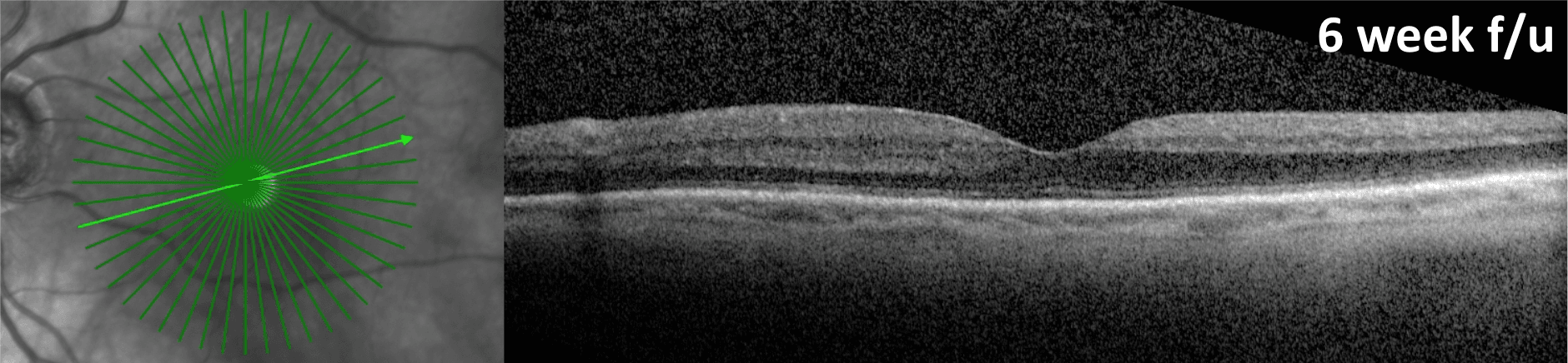 Macular Holes: An Action-Oriented Approach