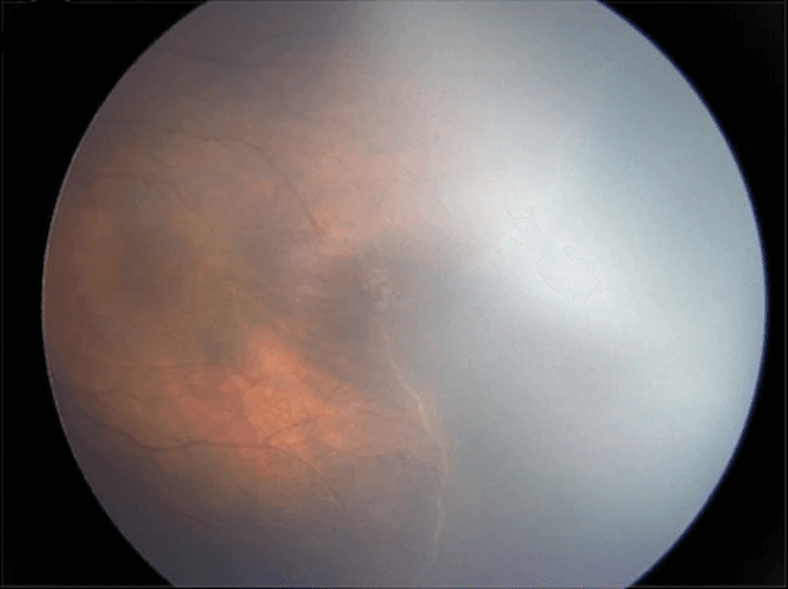 Update on the Diagnosis and Management of Retinopathy of Prematurity