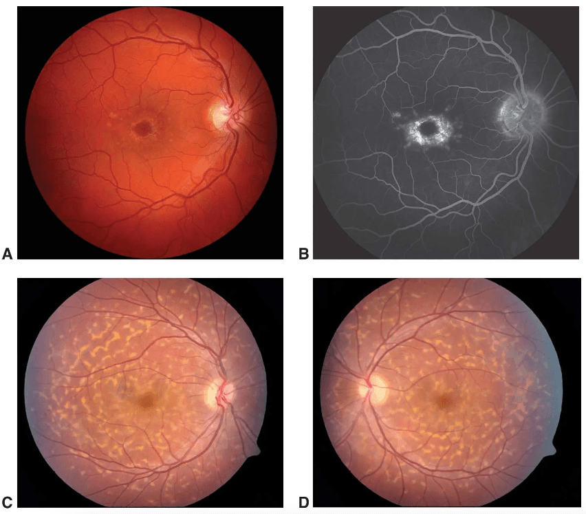 The Ophthalmology Resident's Guide to Inherited Macular Dystrophies ...