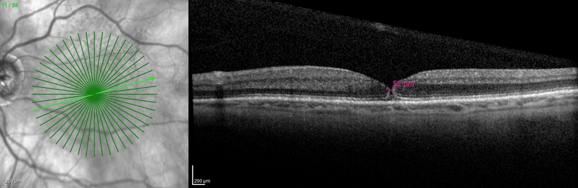 Macular Holes: An Action-Oriented Approach