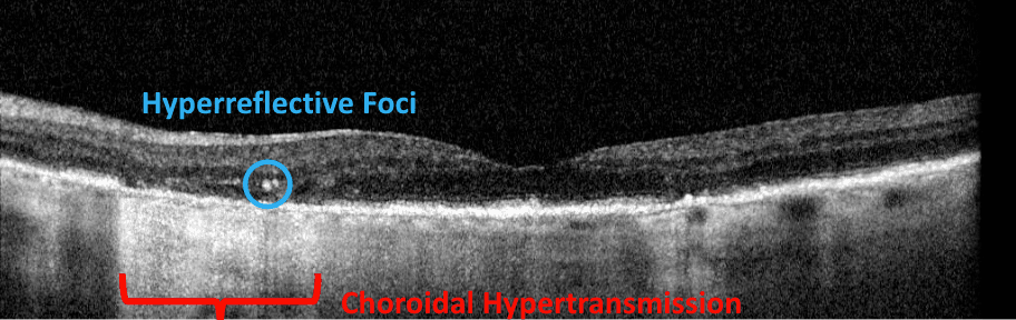Hyper Reflective Defect Oct What Long-Term Care Can Do for Geographic Atrophy Patients