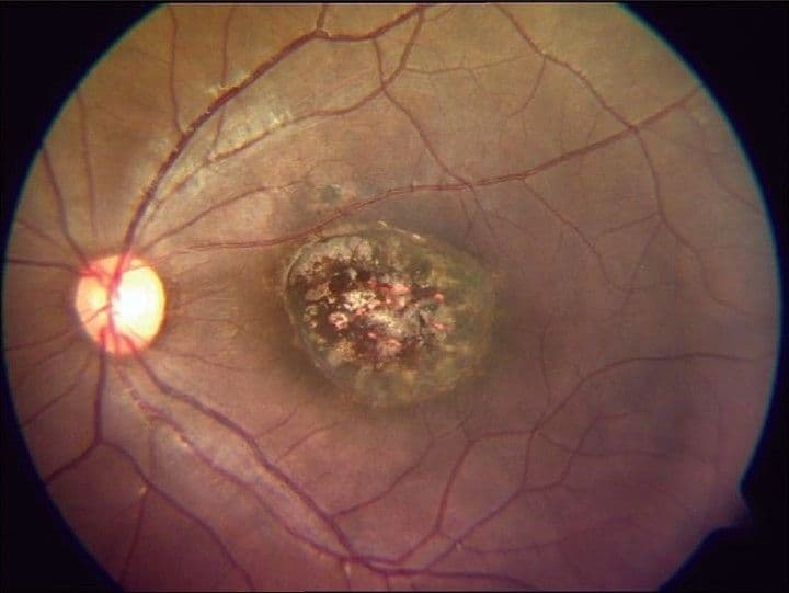 Ocular Manifestations of Systemic Infections: A Concise Overview