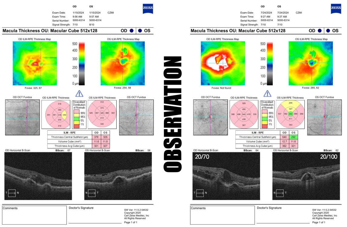 Ga Oct A Curious Case of Aggressive Geographic Atrophy in Wet AMD