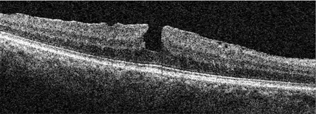 Retinal Undulation Into the Woods: Interpreting OCT Imaging in Retinal Disease