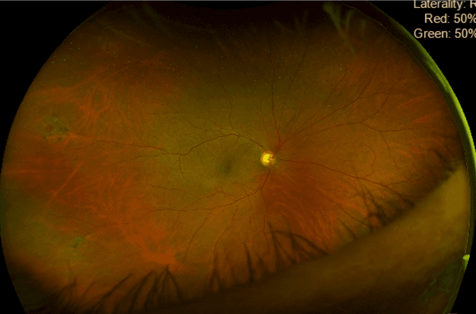 The OD's Guide to Identifying Peripheral Retinal Disease with Cheat Sheet