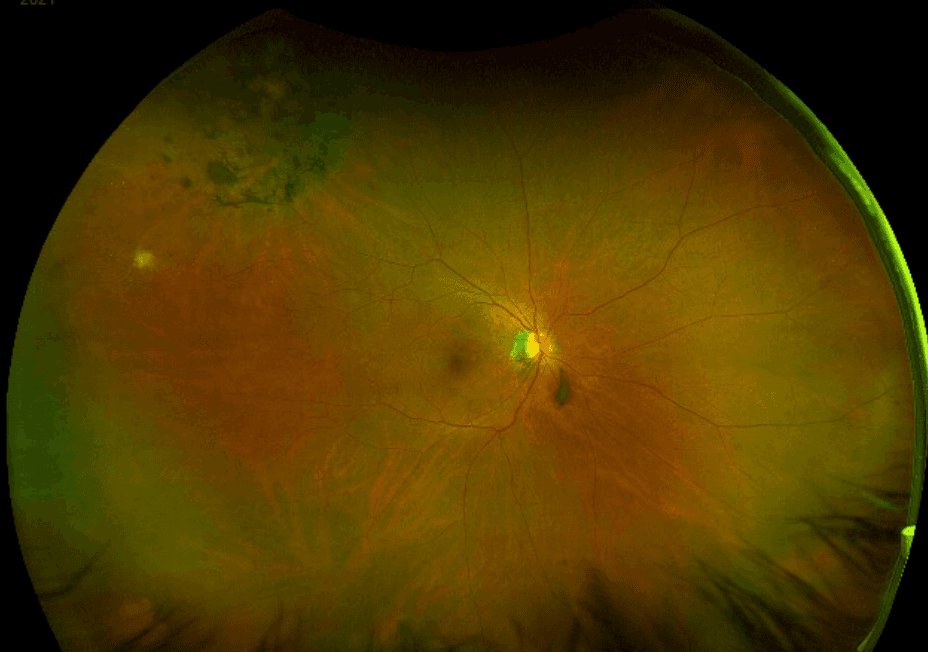 The OD's Guide to Identifying Peripheral Retinal Disease with Cheat Sheet