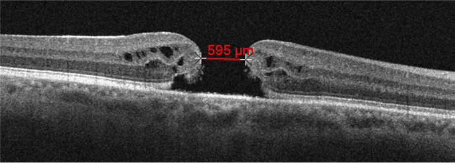 Into the Woods: Interpreting OCT Imaging in Retinal Disease