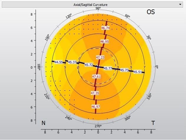 What Improved Toric Lens Design Means for Your Patients