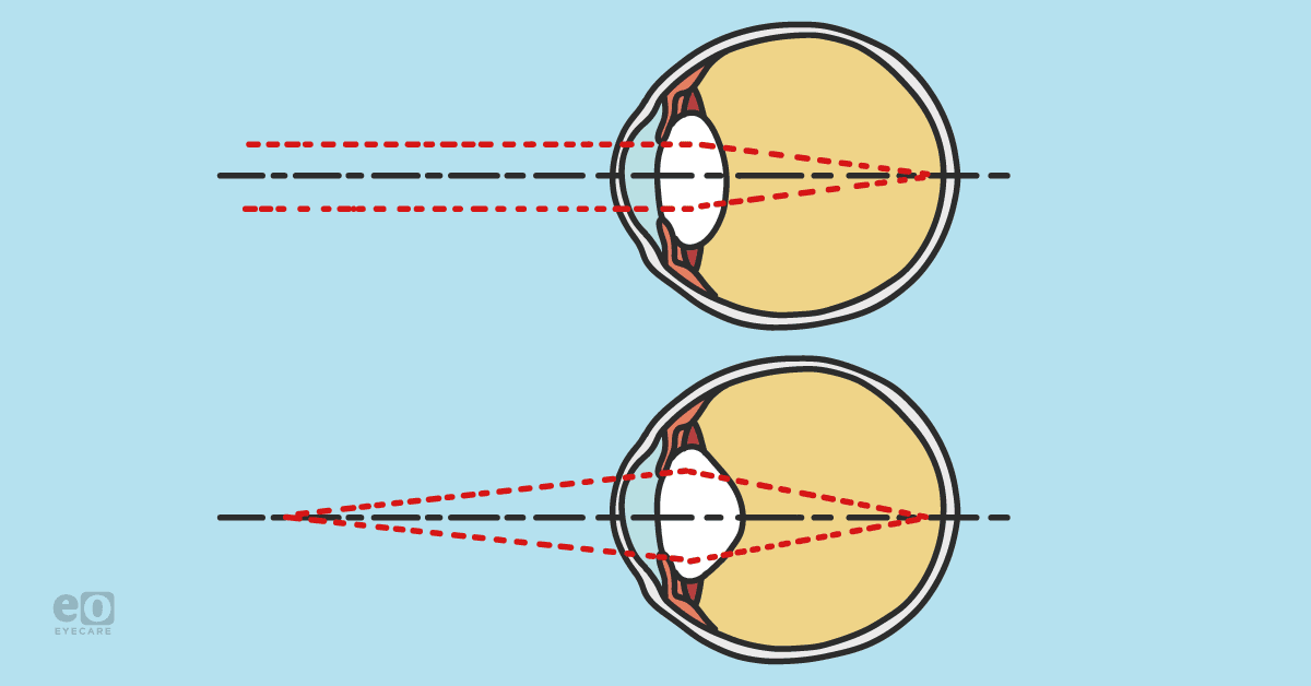Near Point Copy Clinical Signs Suggesting Near Point Stress and Risk of Myopic Progression
