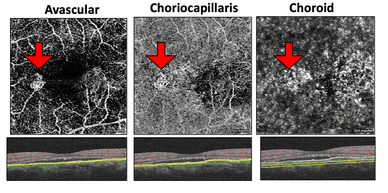 OCT Angiography: Routine to Extreme