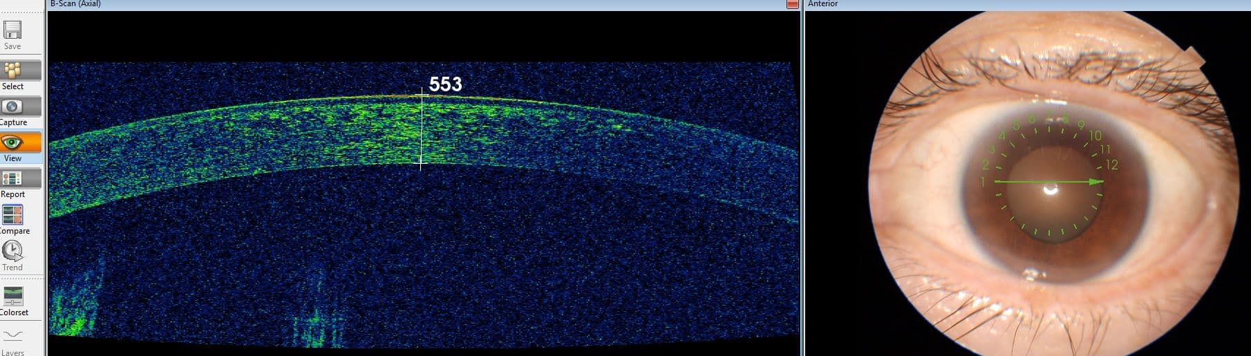 The Basics of Glaucoma for the General Practitioner