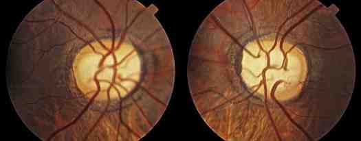 A Guide To Optic Disc Abnormalities With Cheat Sheet a-guide-to-optic-disc-abnormalities-with-cheat-sheet