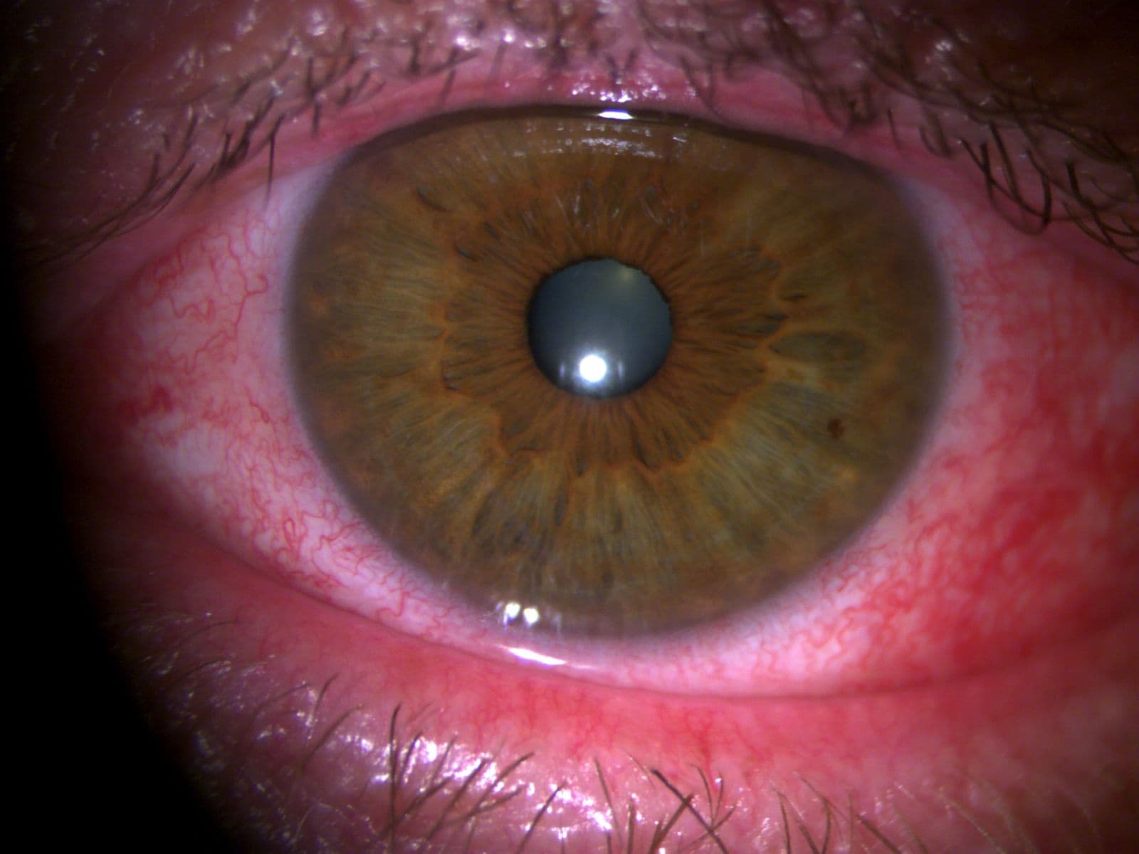 I’ve Seen Better Days: Managing Dry Eye Flares
