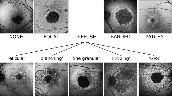 How to Identify Geographic Atrophy Early with Multimodal Imaging