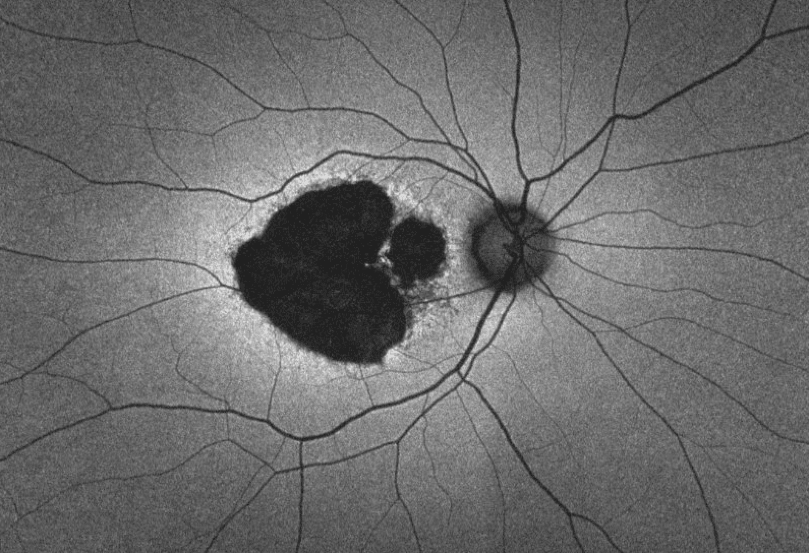 The Ophthalmology Resident's Guide to Inherited Macular Dystrophies ...