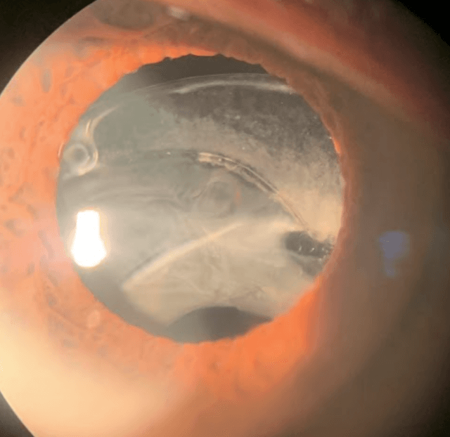 Slight Dislocation Iol Diagnosing and Treating Secondary Glaucomas: A Complete Guide