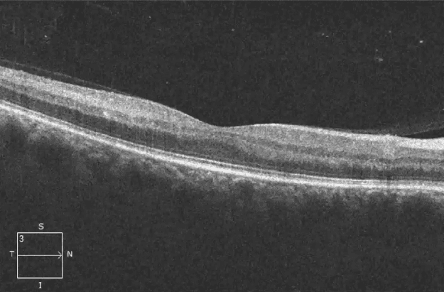 The Great Imitator: Retinal Manifestations of Ocular Syphilis