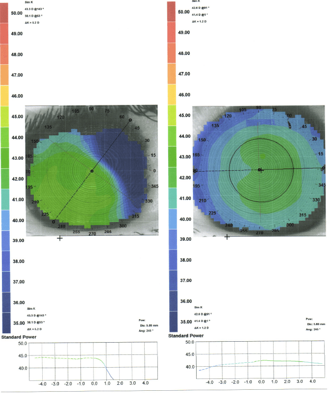 Toroidal Rgp Fitting Pattern A Case Study on the Role of RGP Lenses in Management of Microcornea