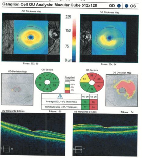 123s of Hydroxychloroquine Retinopathy