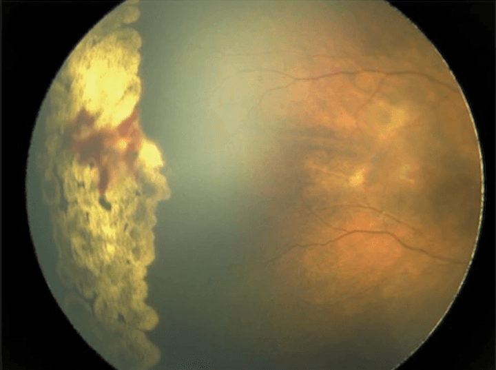 Phoenix Retina Camera Rop Update on the Diagnosis and Management of Retinopathy of Prematurity