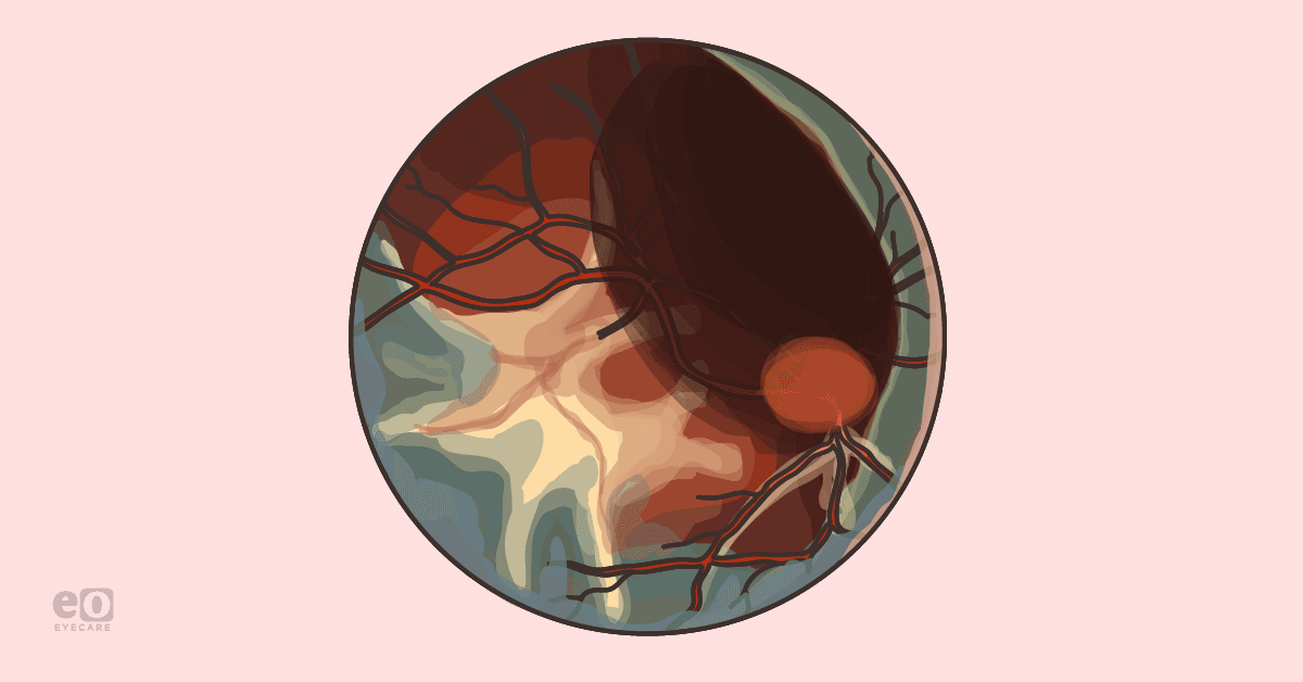 An Introduction to Metamorphopsia Following Retinal Detachment Repair ...