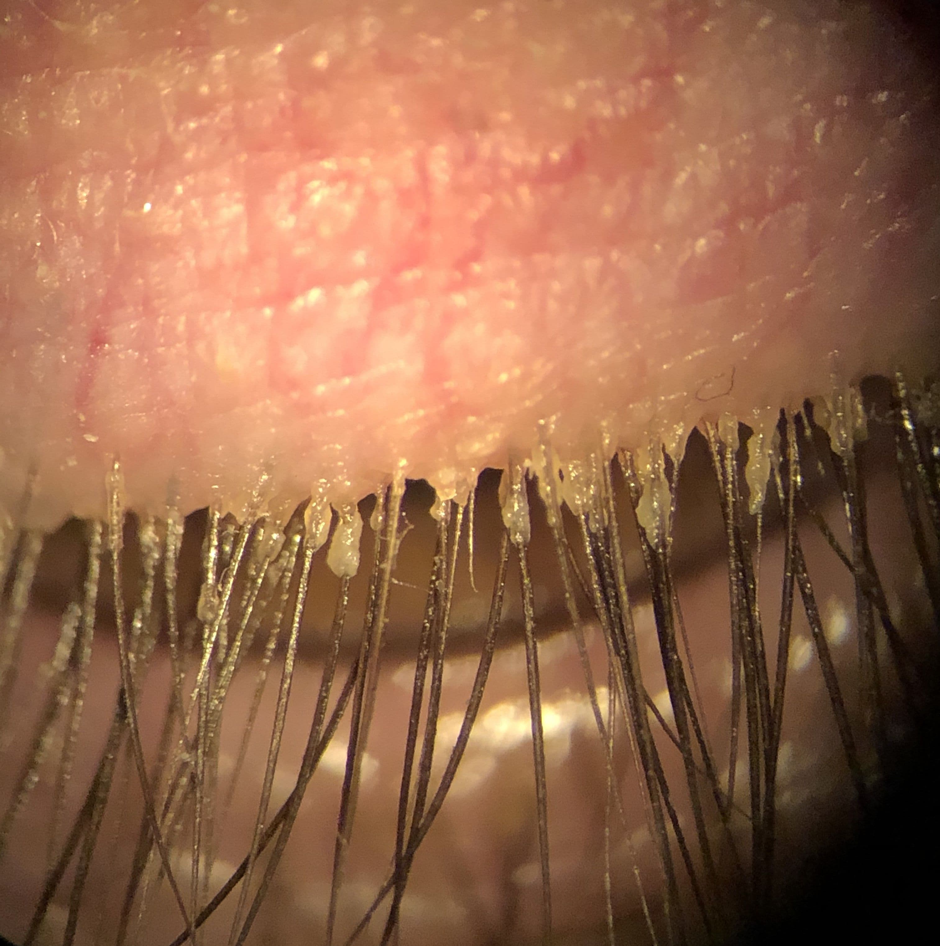 Overcoming Mite Fright How To Talk To Patients About Demodex Blepharitis overcoming-mite-fright-how-to-talk-to-patients-about-demodex-blepharitis